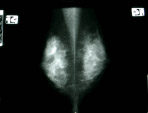 乳房撮影X線画像