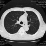 写真：胸部X線CT　肺の横断像