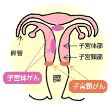 図：2種類の子宮がん